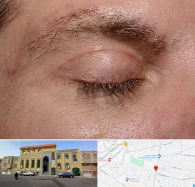 جراح بلفاروپلاستی در زنبیل آباد قم