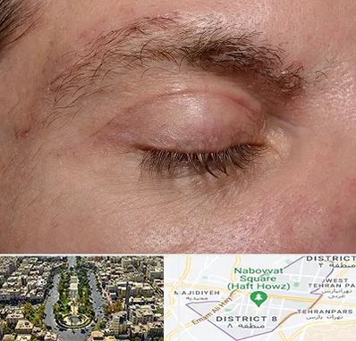 جراح بلفاروپلاستی در نارمک 