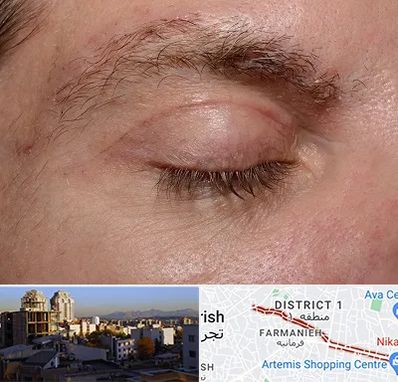 جراح بلفاروپلاستی در فرمانیه 