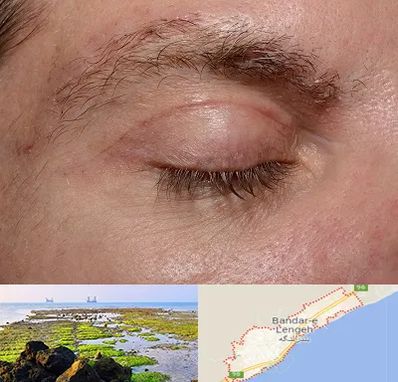 جراح بلفاروپلاستی در بندرلنگه