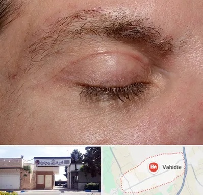 جراح بلفاروپلاستی در وحیدیه شهریار