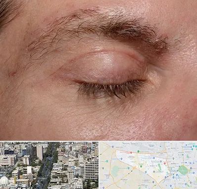 جراح بلفاروپلاستی در منطقه 18 تهران 