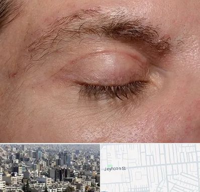 جراح بلفاروپلاستی در جیحون