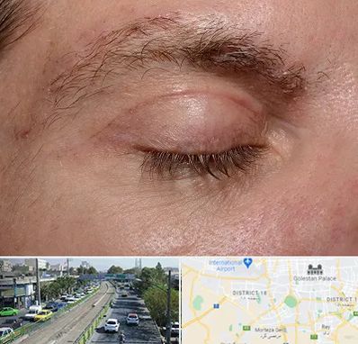 جراح بلفاروپلاستی در جنوب تهران 