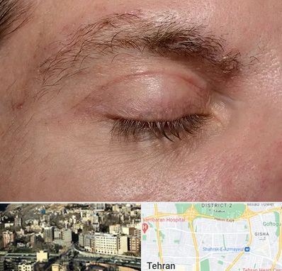 جراح بلفاروپلاستی در مرزداران 