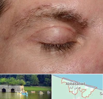 جراح بلفاروپلاستی در عباس آباد