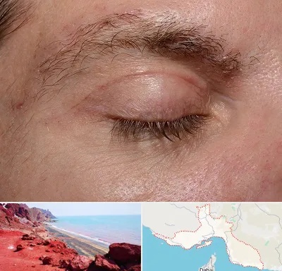 جراح بلفاروپلاستی در هرمزگان
