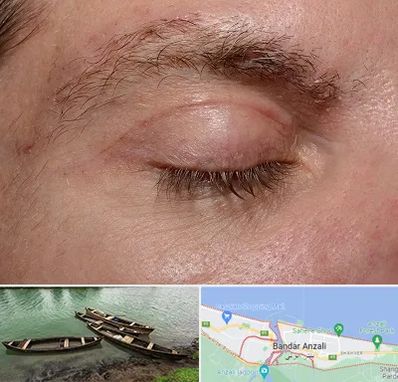 جراح بلفاروپلاستی در بندر انزلی