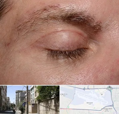 جراح بلفاروپلاستی در مهرآباد