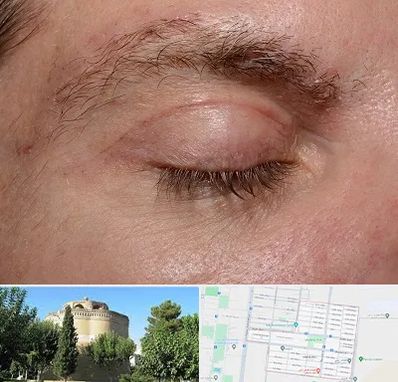 جراح بلفاروپلاستی در مرداویج اصفهان