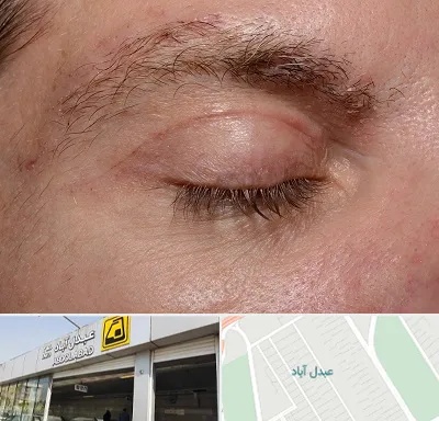 جراح بلفاروپلاستی در عبدل آباد