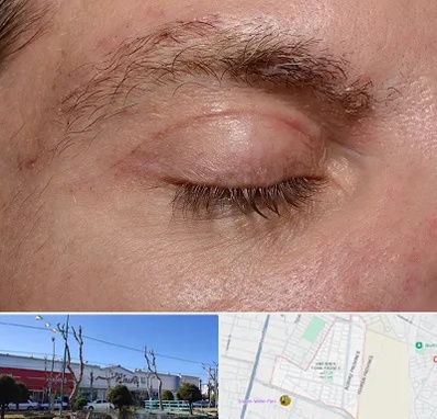 جراح بلفاروپلاستی در فاز دو اندیشه
