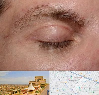 جراح بلفاروپلاستی در هاشمیه مشهد