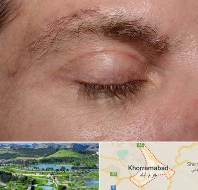 جراح بلفاروپلاستی در خرم آباد