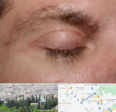 جراح بلفاروپلاستی در محلاتی شیراز