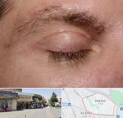 جراح بلفاروپلاستی در پرواز تبریز