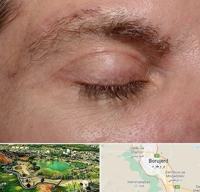 جراح بلفاروپلاستی در بروجرد