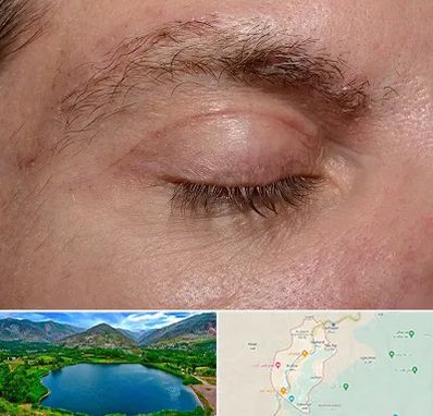 جراح بلفاروپلاستی در رودبار