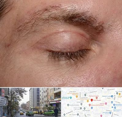 جراح بلفاروپلاستی در فاطمی 