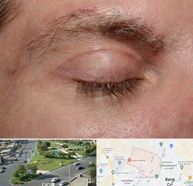 جراح بلفاروپلاستی در شاهین ویلا کرج