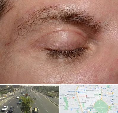 جراح بلفاروپلاستی در منطقه 17 تهران 