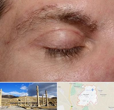 جراح بلفاروپلاستی در مرودشت