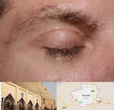 جراح بلفاروپلاستی در ساوه