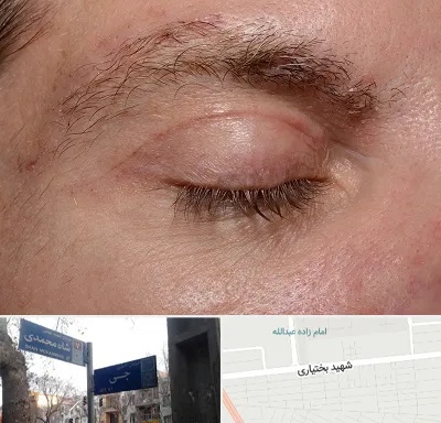 جراح بلفاروپلاستی در سی متری جی