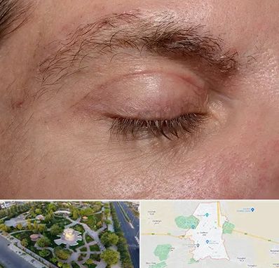 جراح بلفاروپلاستی در کاشمر