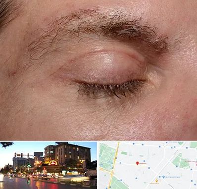 جراح بلفاروپلاستی در بلوار سجاد مشهد 