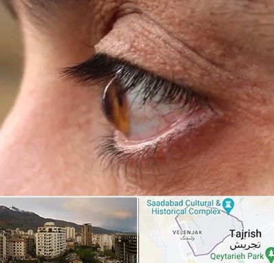 متخصص قوز قرنیه در زعفرانیه 