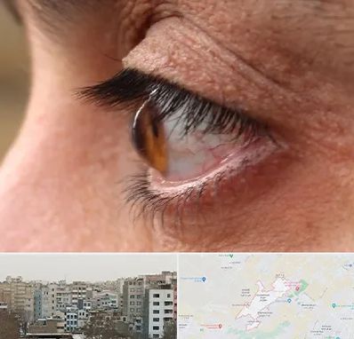 متخصص قوز قرنیه در محمد شهر کرج 