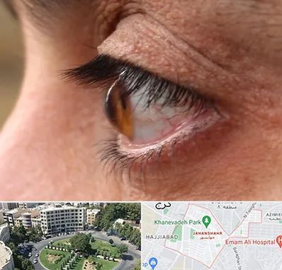 متخصص قوز قرنیه در جهانشهر کرج 