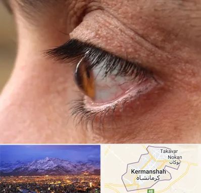 متخصص قوز قرنیه در کرمانشاه