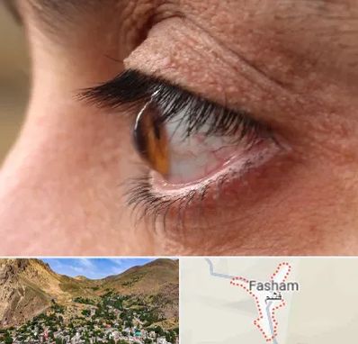 متخصص قوز قرنیه در فشم