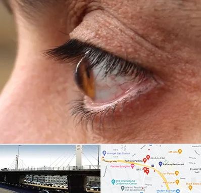 متخصص قوز قرنیه در پارک وی 