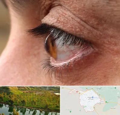 متخصص قوز قرنیه در بهبهان