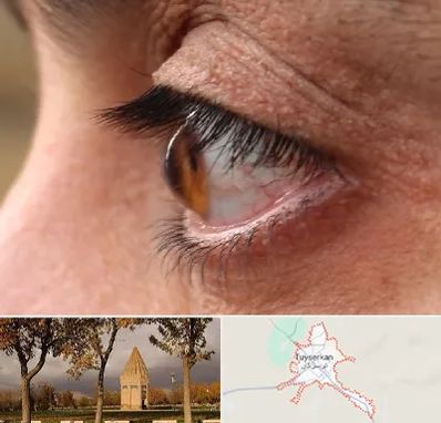 متخصص قوز قرنیه در تویسرکان