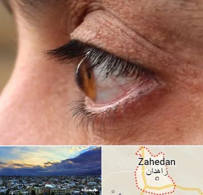 متخصص قوز قرنیه در زاهدان