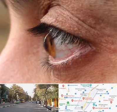 متخصص قوز قرنیه در شریعتی 