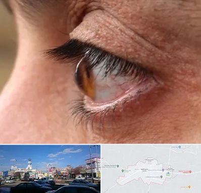 متخصص قوز قرنیه در ماهدشت کرج 