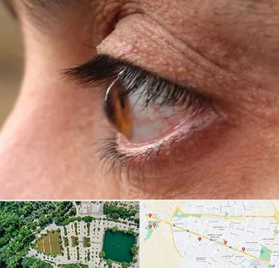 متخصص قوز قرنیه در وکیل آباد مشهد 