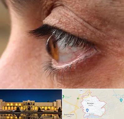 متخصص قوز قرنیه در برازجان