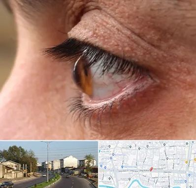 متخصص قوز قرنیه در ضیابری رشت