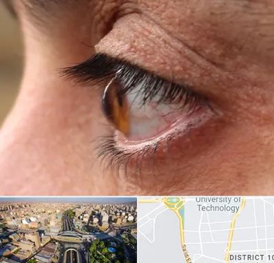 متخصص قوز قرنیه در استاد معین 