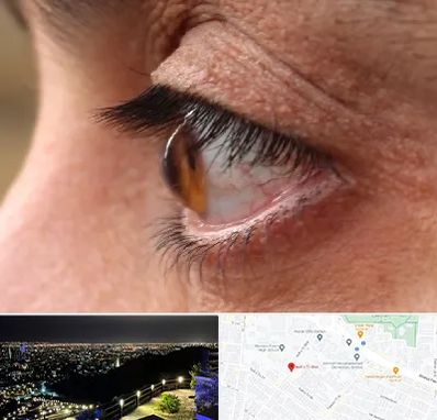 متخصص قوز قرنیه در هفت تیر مشهد 