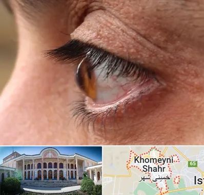 متخصص قوز قرنیه در خمینی شهر