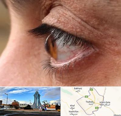 متخصص قوز قرنیه در تایباد