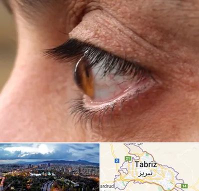 متخصص قوز قرنیه در تبریز