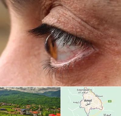 متخصص قوز قرنیه در آمل